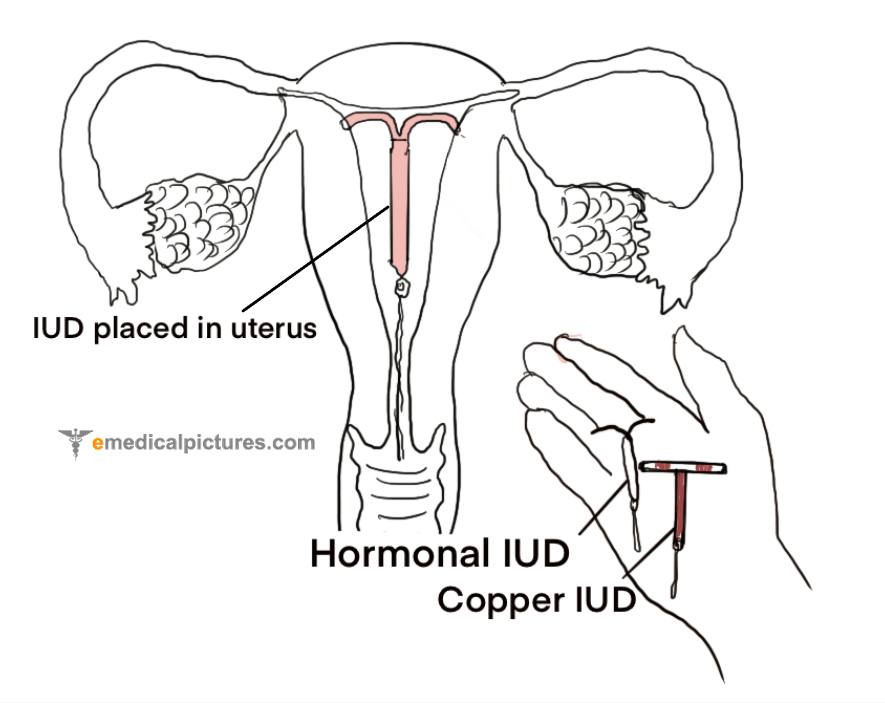 IUD (Intrauterine device) Diagram and Images Medical Pictures and