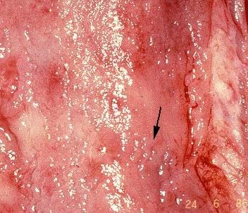 Ulcerative Colitis, Physiopathology, Diagnosis, Treatment ... ulcerative colitis diagram 