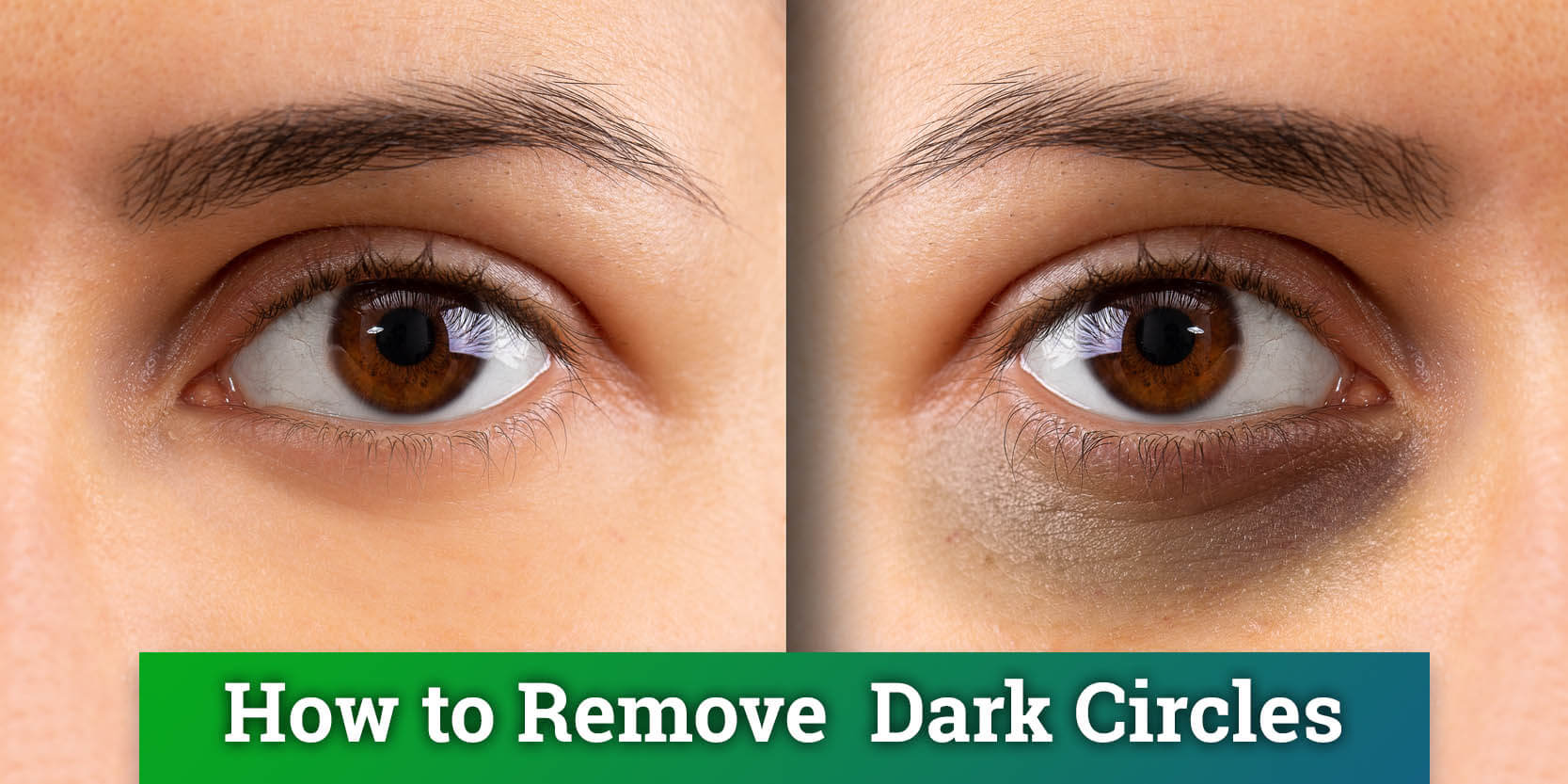 How To Get Rid Of Dark Circles Healthy Lifestyle