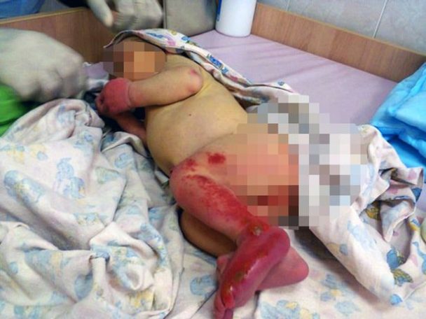 HEART-BREAKING! 3-day-old Abandoned Baby, Eaten alive by Ants in a Forest HEART-BREAKING! 3-day-old Abandoned Baby, Eaten alive by Ants in a Forest