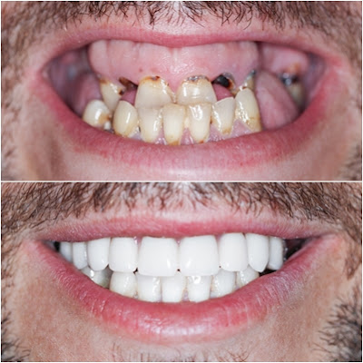 implantes carga imediata