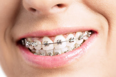 Các giai đoạn niềng răng hô người chỉnh nha cần nắm rõ 1