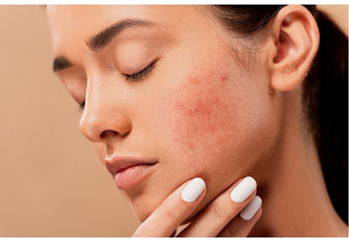 what would a dermatologist prescribe for acne or Pimple ?