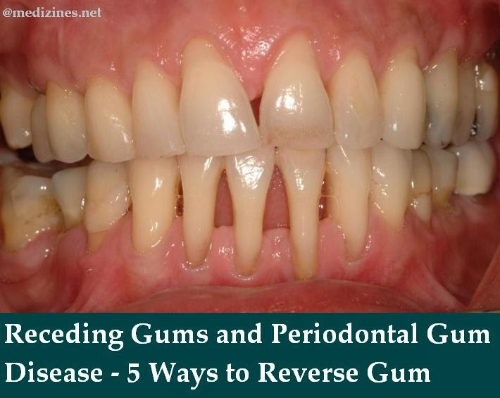 Quinnipiac University Transfer Hydrogen Peroxide Gum Disease Treatment