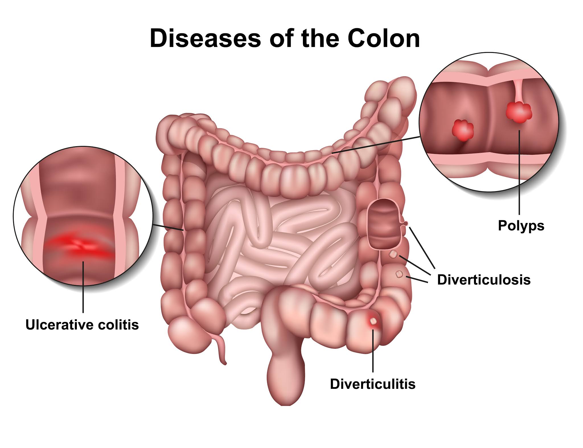 Alimentacion diverticulos colon