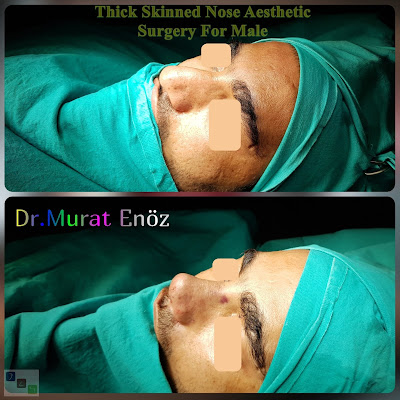 Thick Skinned Nose Aesthetic Surgery For Male Istanbul Turkey Rhinoplasty Men
