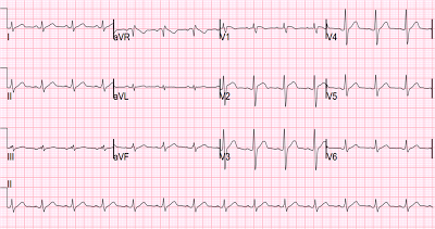 Dr. Smith's ECG Blog: Brugada pattern induced by tricyclic antidepressant