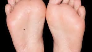 #25. A mole at the bottom of the feet symbolizes someone who needs to travel. - These Moles On Your Body May Reveal Secrets About Your Life. #25. A mole at the bottom of the feet symbolizes someone who needs to travel. - These Moles On Your Body May Reveal Secrets About Your Life.