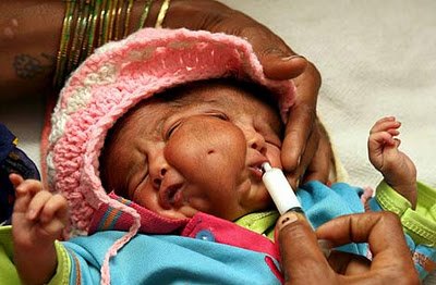 Heboh! Bayi Bermata 4 Dan Berkepala 2 Dari India [ www.BlogApaAja.com ]
