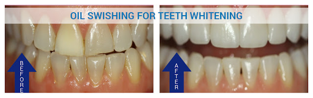 Oil Swishing for Teeth Whitening