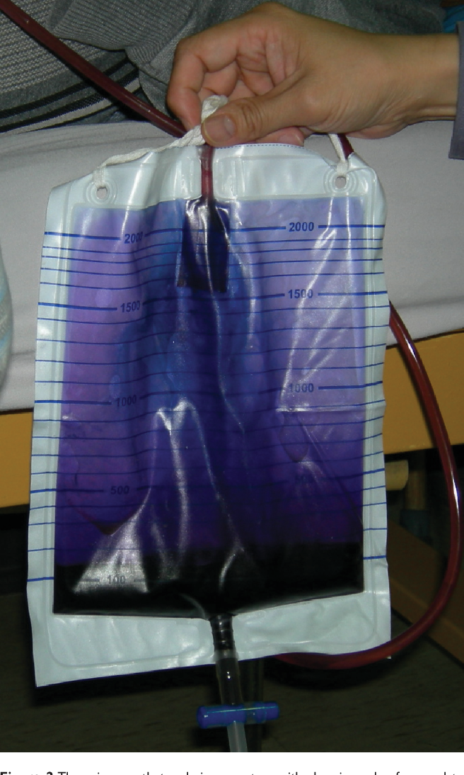 Strange Syndromes Purple Urine Bag Syndrome