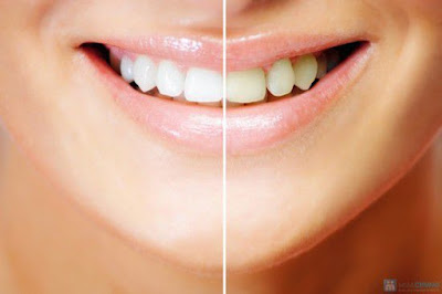 Tẩy trắng răng bằng miếng dán có được không?