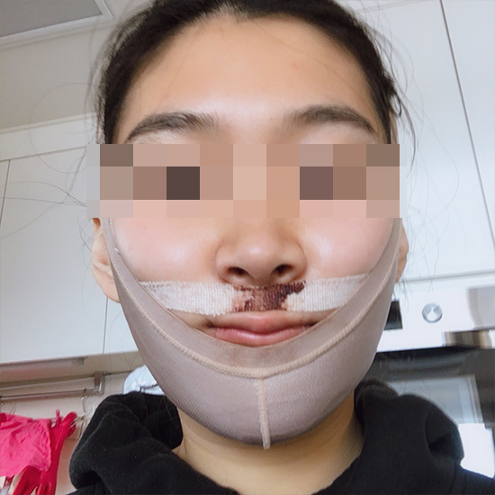 Lantern jaw & long face has been improved from double jaw surgery? Post