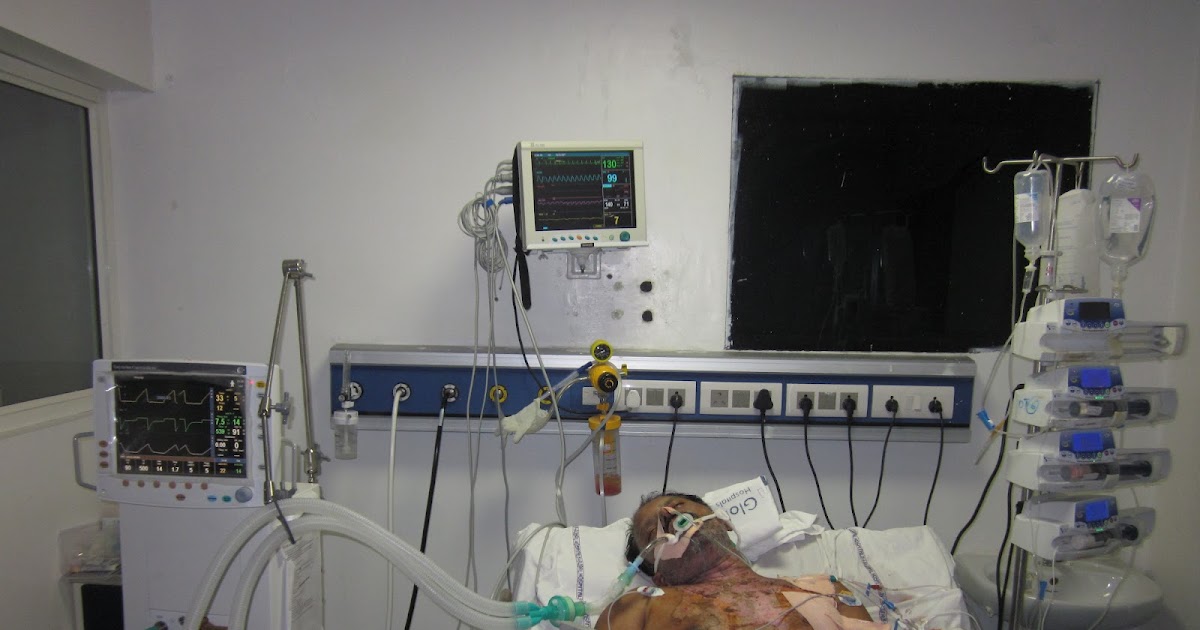 BURN INJURY , HAND BURNS, ELECTRICAL BURNS. SEPTICEMIA FOLLOWING