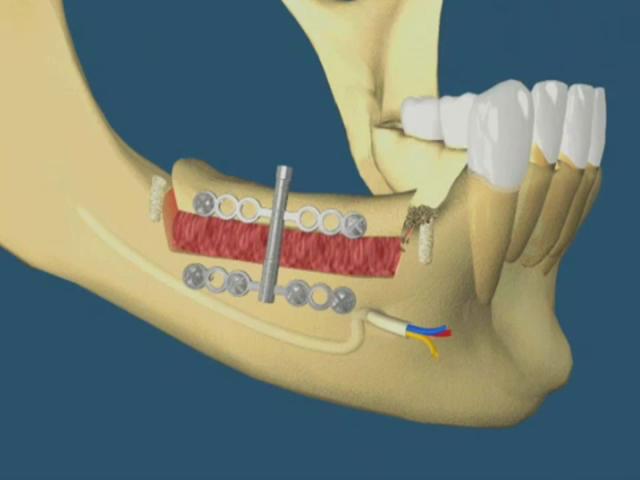 distraccion osteogenica mandibular