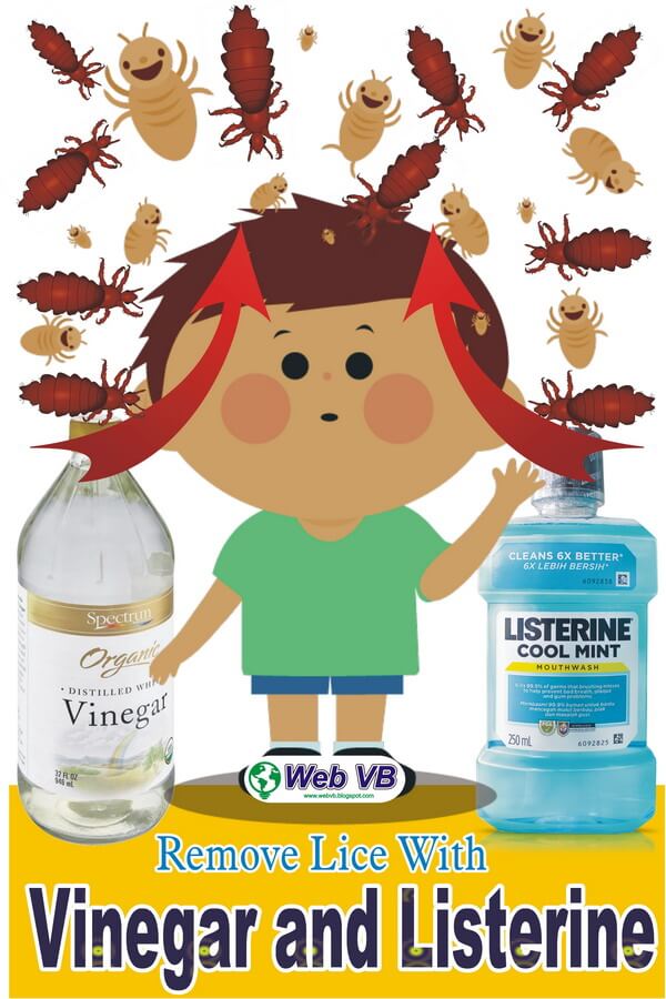 VB How to Get Rid of Lice with Vinegar and Listerine StepbyStep