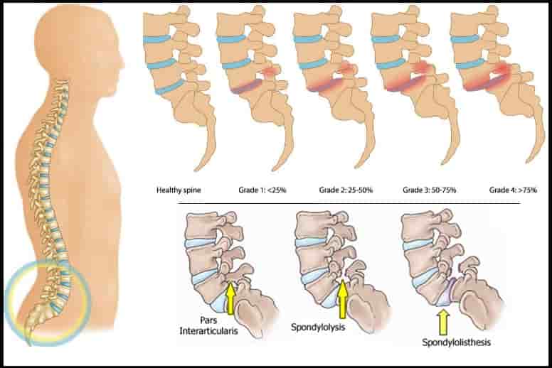 L4-l5 spondylolisthesis symptoms picture