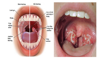 Viêm họng hạt là bệnh gì, Nguyên nhân do đâu