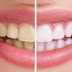 Các bước tẩy trắng răng tại nha khoa