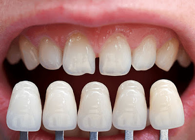 Khắc phục răng sứ bị hở thế nào? 