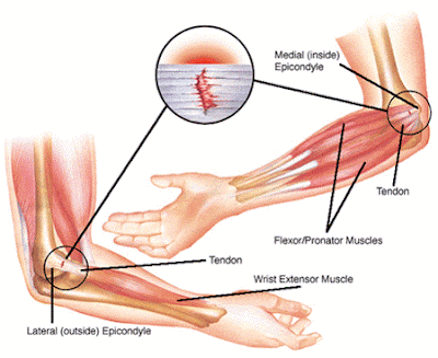 gambar tenis elbow