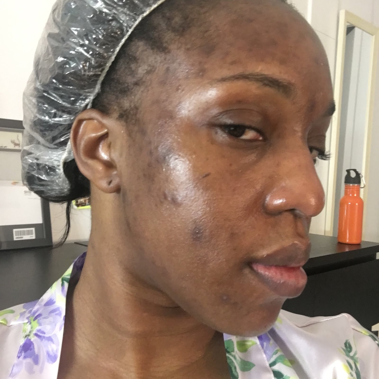 My Chemical Peel Experience - APS Pigment Peel - SKIN FIRST DAILY
