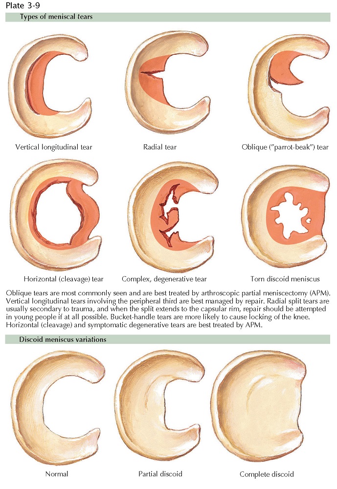 TYPES OF MENISCAL TEARS AND DISCOID MENISCUS VARIATIONS
