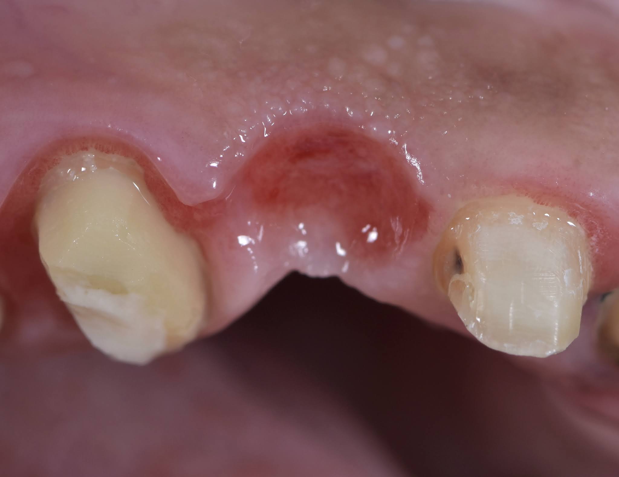 Dental Esthetics Ovate pontic for the correct emergence profile.. A clinical case