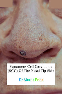 Squamous Cell Carcinoma, SCC, The Nasal Tip Skin Cancer, Nose Tumor