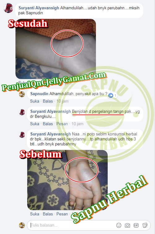 Obat Benjolan Di Selangkangan Paha Tradisional ,TERBUKTI Manjur!! Obat Benjolan Di Selangkangan Paha Tradisional ,TERBUKTI Manjur!!