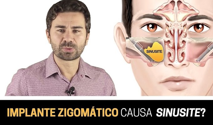 Implante Zigomático Causa Sinusite? - Fernando Giovanella