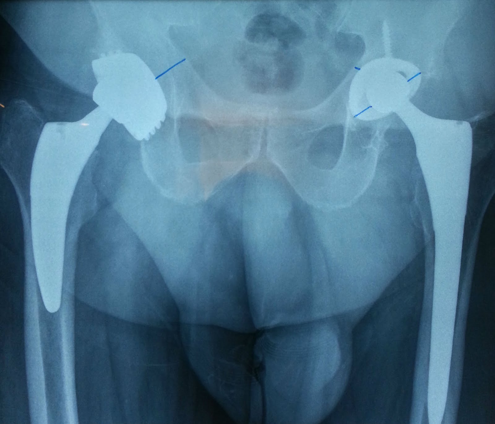 THREADED ACETABULAR IMPLANT WITH EXCELLENT OSSEOINTEGRATION (R-SIDE),  USUAL IMPLANT (L-SIDE)