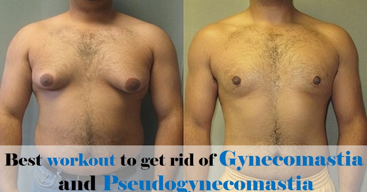 Best Workout To Get Rid Of Gynecomastia And Pseudogynecomastia Gynecomastia And Pseudogynecomastia Best Workout To Get Rid Of Gynecomastia And Pseudogynecomastia Gynecomastia And Pseudogynecomastia