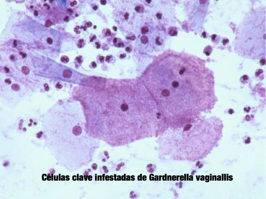 Citología Exfoliativa Mérida Gardnerella Vaginallis Qué es la