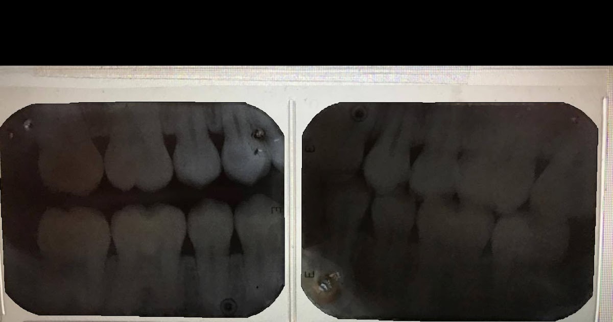 Radiología Dental Examen intraoral Interproximal