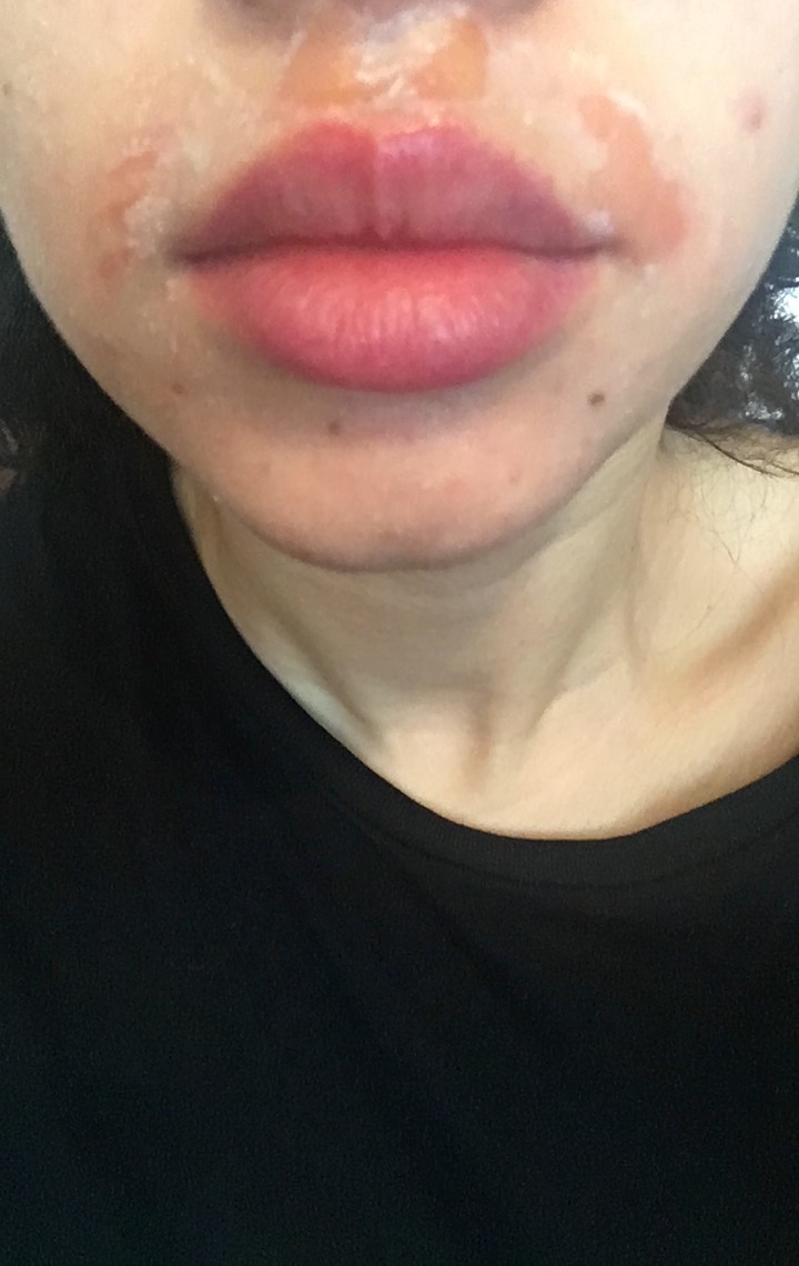 How To Treat Burn Marks From Waxing On Face Heal Info