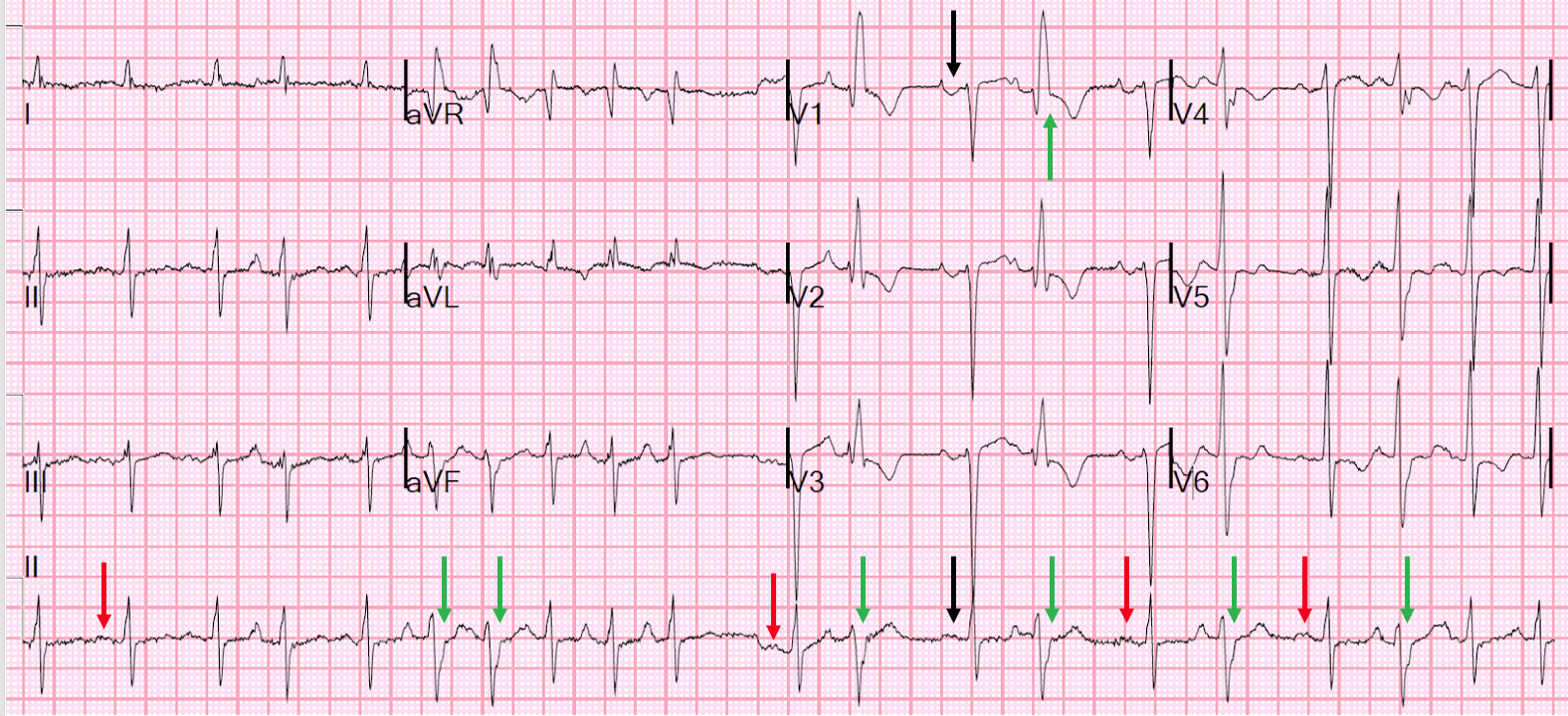 Dr. Smith's ECG Blog: Atrial fibrillation? Multifocal Atrial Tachycardia?  Don't look at computer read until AFTER you interpret!