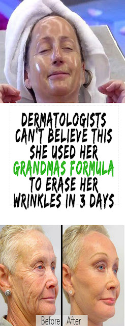 DERMATOLOGISTS CAN’T BELIEVE THIS SHE USED HER GRANDMAS FORMULA TO ERASE HER WRINKLES IN 3 DAYS