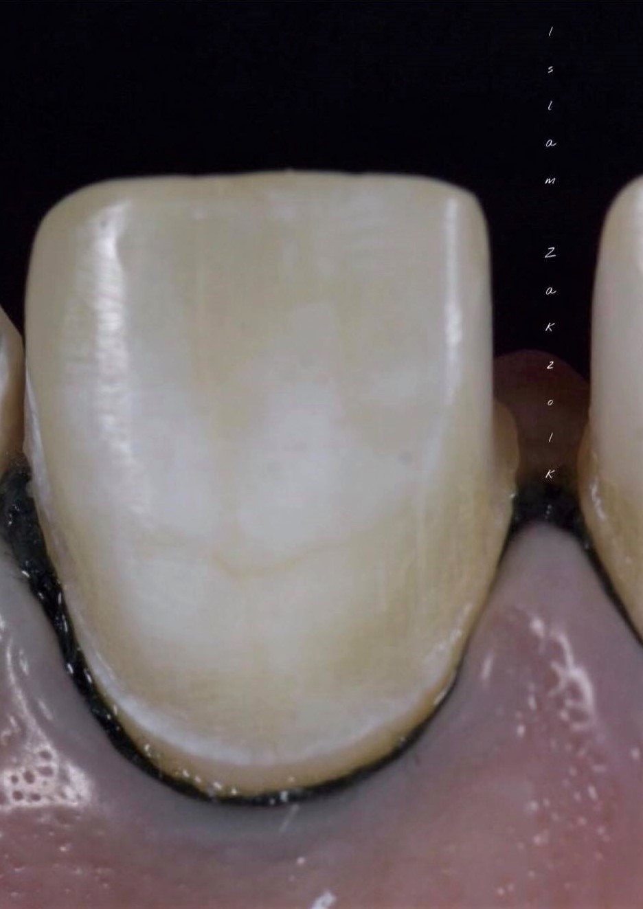 Ceramic veneers preparartion .. Part 2 " Conventional preparation