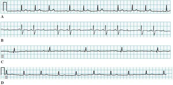 Types of atrioventricular