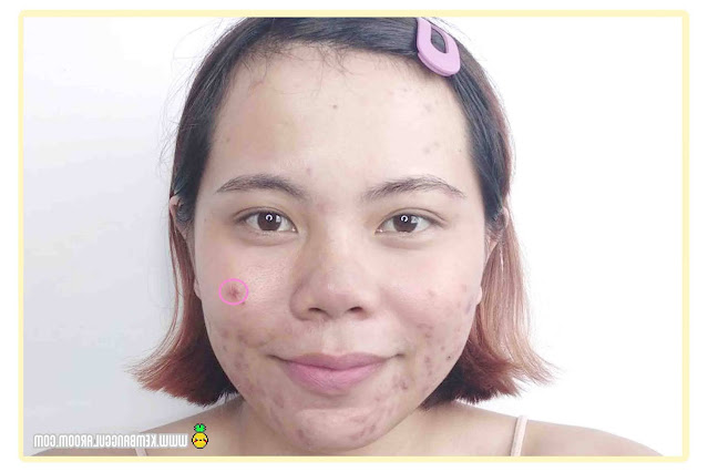 Acne Care Treatment di TIUwoo Korean Beauty, Perawatan Wajah untuk Kulit Berjerawat