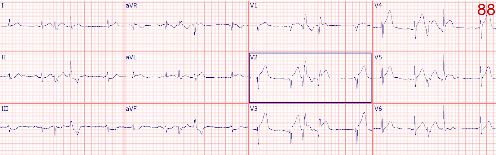 Dr. Smith's ECG Blog Anterior STEMI and multiform PVCs with Narrow