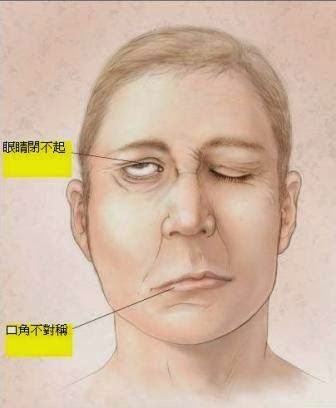 舒緩顏面神經麻痺　肌肉運動配合物理治療