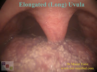 Elongated (Long) Uvula