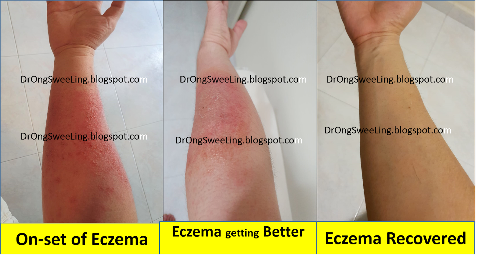 TCM News Are you looking for TCM Eczema Specialist or TCM Dermatologist?