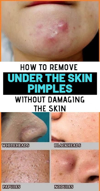 How to Remove Pimple Under Skin: Conquer Stubborn Blemishes!