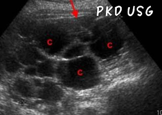 Polycystic kidney disease ultrasound