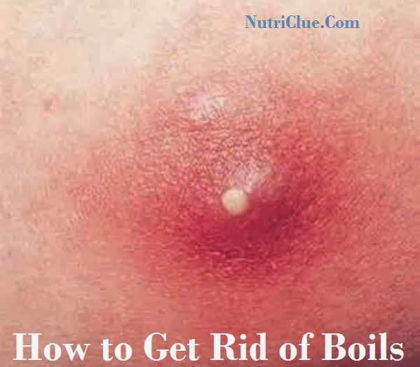 Boils - Treatments, Causes, Symptoms of Boils - WebMD