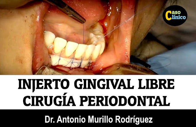 CIRUGÍA PERIODONTAL: Injerto gingival libre - Dr. Antonio Murillo Rodríguez