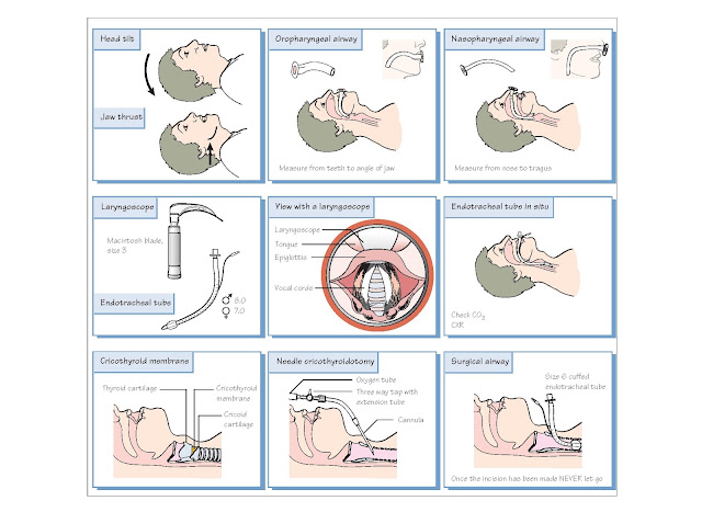 Airway Management And Sedation, Oxygenation and ventilation, Ventilatory failure, Suction, Airway support, Laryngeal mask airway, Endotracheal tube, Surgical airway, Procedural sedation,  